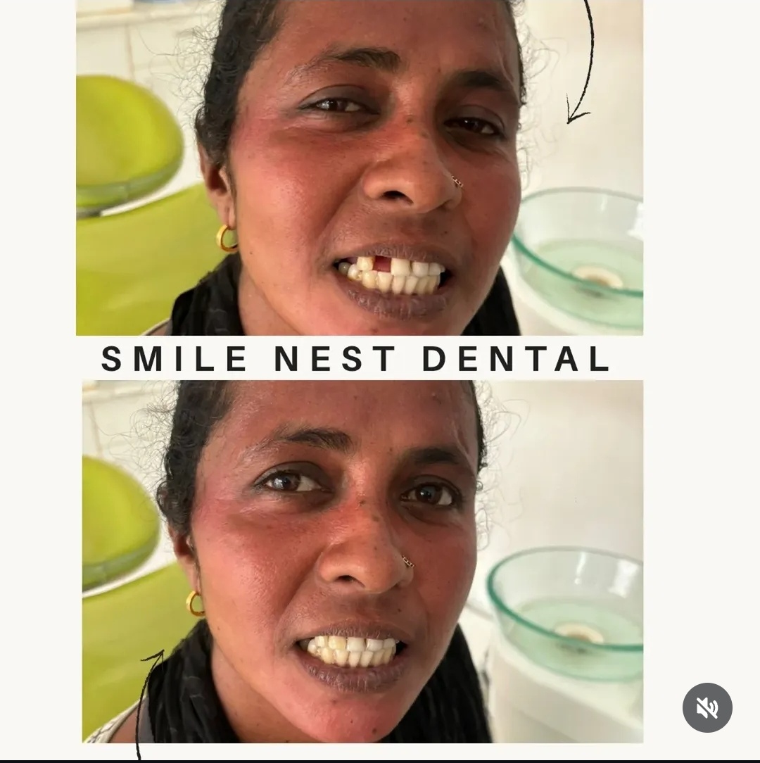 Smile transformation before and after