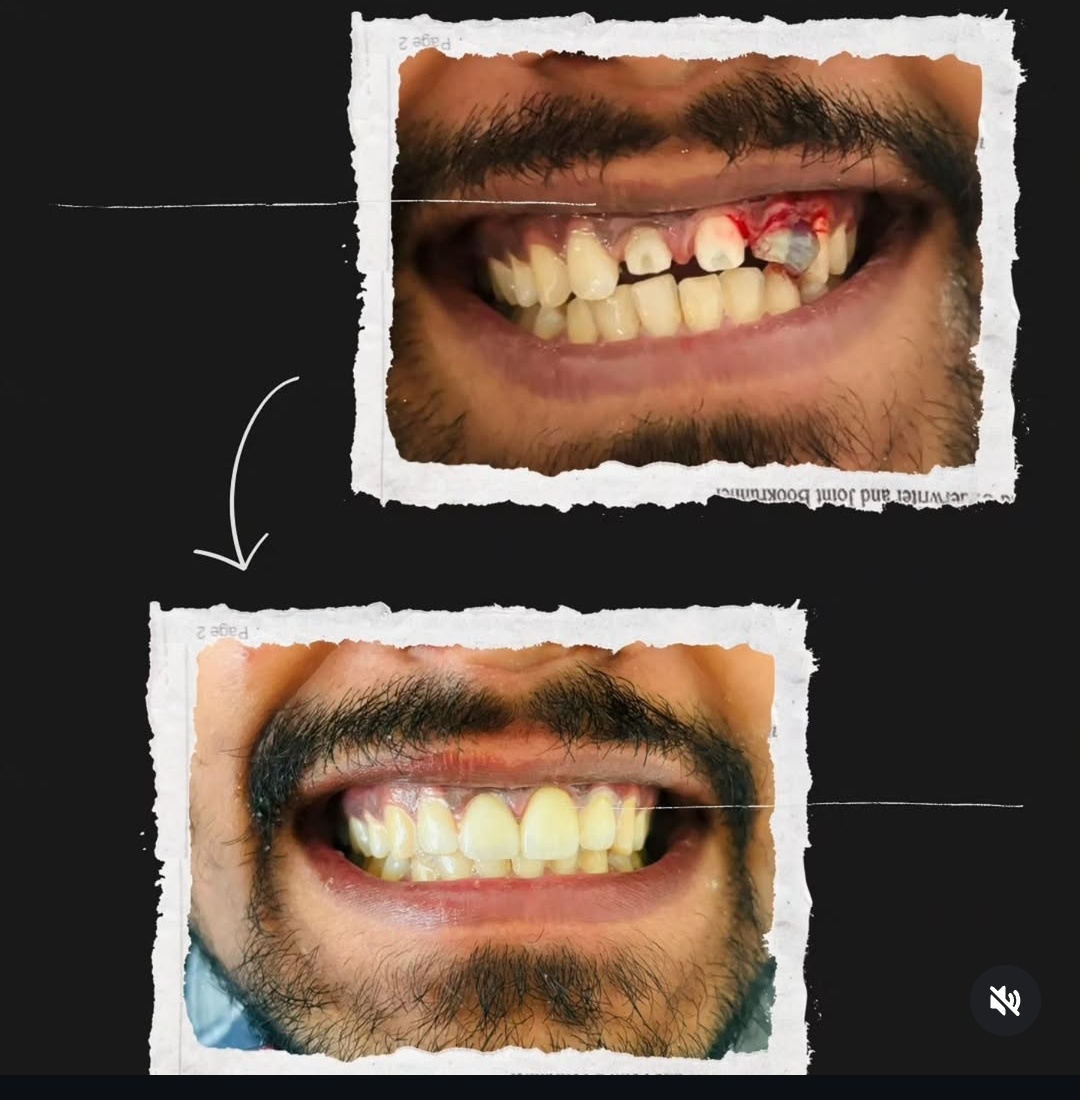 Smile transformation before and after