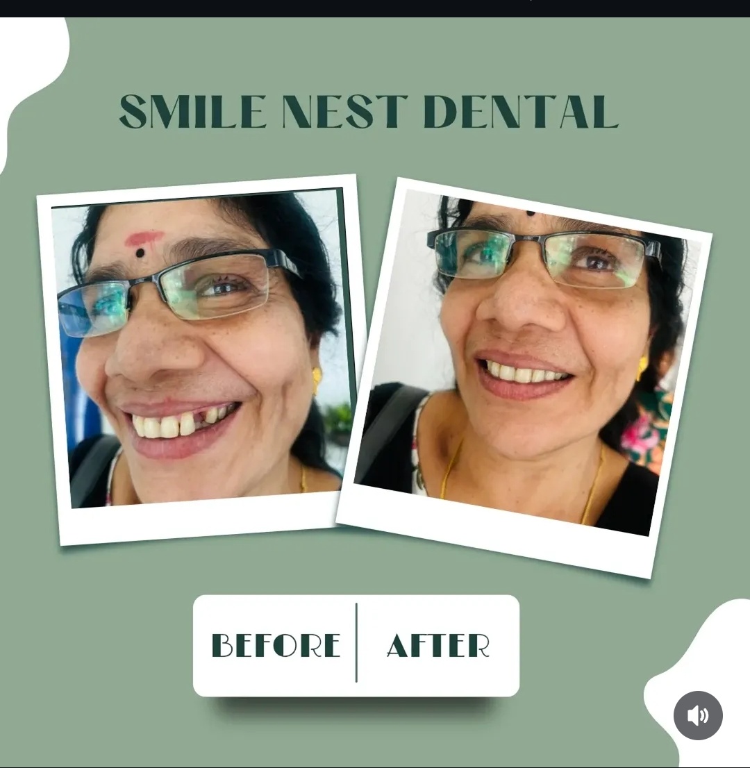 Smile transformation before and after